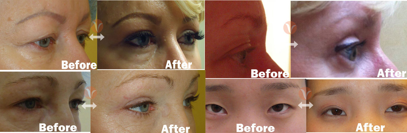 Liposuction Techniques