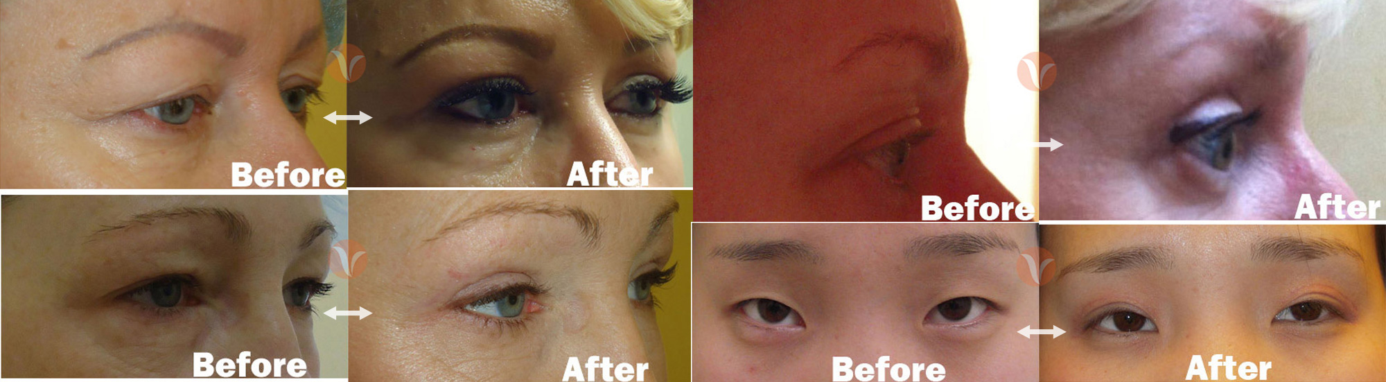 Liposuction In New York City